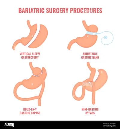 Bariatric Surgery (Sleeve Gastrectomy / Gastric Bypass)