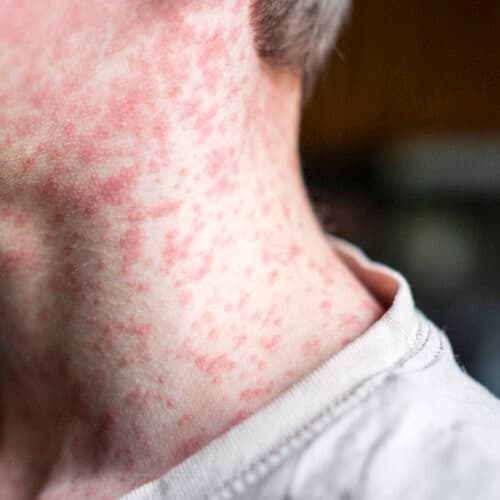#10 18-year-old dies of measles in PA from severe neurological complication — Top 10 Ars Technica — Latest — September 16, 2026